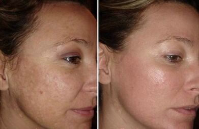Rejuvenarea pielii faciale laser înainte și după fotografii
