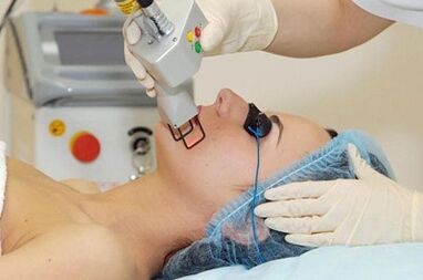 Tipuri de întinerire a pielii faciale laser